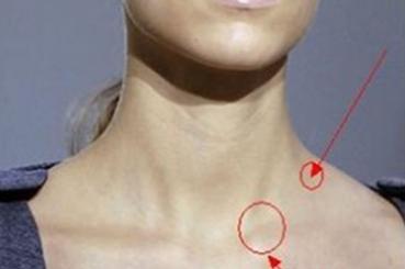 锁骨上淋巴结肿大 锁骨上淋巴结肿大 人为什么会淋巴结肿大呢