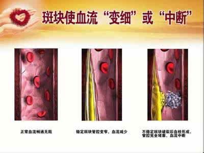 高脂血症的自然疗法 中医浴疗系列：高脂血症和高蛋白血症