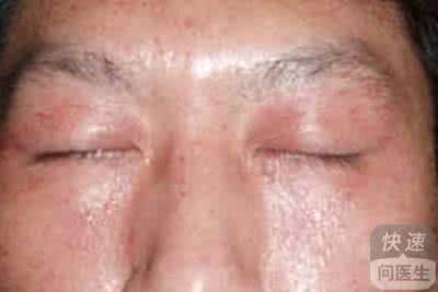 油脂性皮炎 油脂性皮炎 6招帮你轻松搞定油脂性皮炎