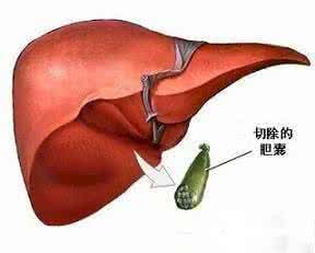 胆囊切除后可以吃虾吗 胆囊切除可以吃蛇吗？