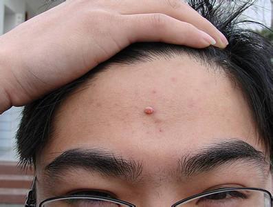 额头长了个硬包按着疼 额头上长疙瘩