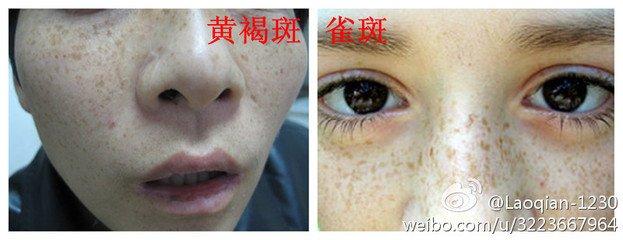 怎么区分黄褐斑和雀斑 怎样区分雀斑和黄褐斑