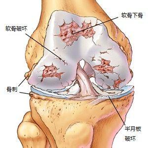 膝关节骨性关节炎 膝关节骨性关节炎的非手术疗法