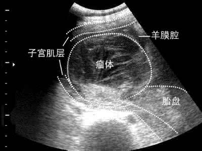 胎盘异常的超声检查 胎盘异常是什么