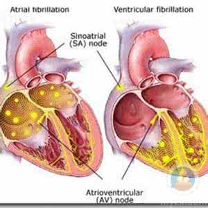怎样治疗手颤 房颤治疗方法 怎样能够治愈房颤