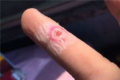 脚上长鸡眼怎么去除 鸡眼复发 长了鸡眼, 1个小方法就能去除不复发, 几毛钱就足够了!