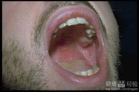 列宁死于梅毒并发症 列宁死于性病梅毒 列宁死于梅毒并发症