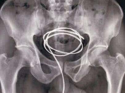 钢珠能从膀胱尿出来吗 惊呆了 男子膀胱内取出“钢珠块”