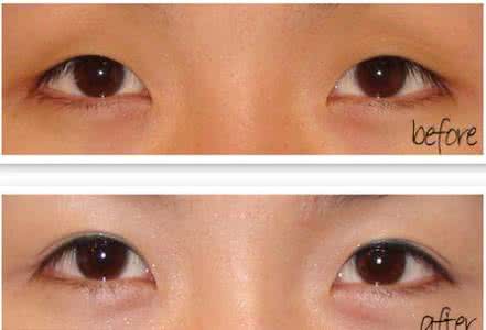 内眦赘皮手术多少钱 内眦赘皮手术多少钱 做开内眼角手术治疗内眦赘皮