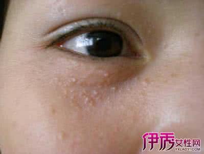 治疗扁平疣有哪些方法 扁平疣治疗 哪些方法能治扁平疣