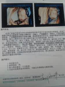 四维彩超什么时候查 查四维彩超要注意什么 四维彩超什么时候做合适