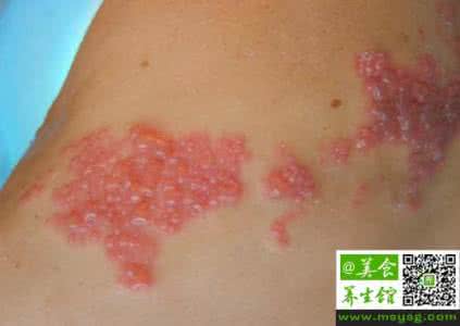 带状疱疹治疗偏方大全 治带状疱疹偏方