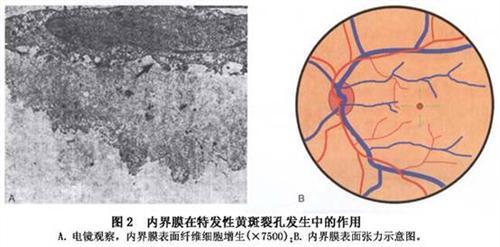 黄斑裂孔的治疗方法 黄斑裂孔 黄斑裂孔的治疗与预防