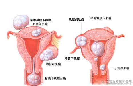 子宫肌瘤症状有哪些 详解子宫肌瘤产生的三大因素及症状