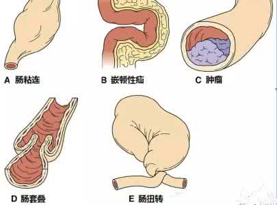 一周内减肥速成法 便秘速效法、一周内把肠道洗得干干净净