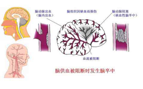 脑卒中和脑中风 “卒中沙龙” 斩断“脑中风”的萌芽