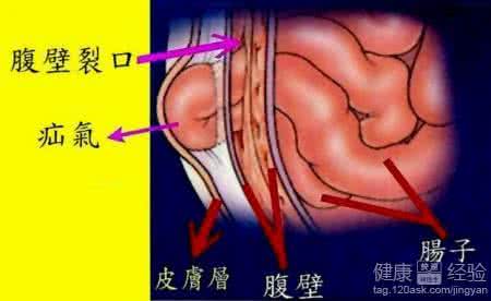 老年人疝气怎么治疗 老年疝气治疗 你绝对想不到吃能治疝气