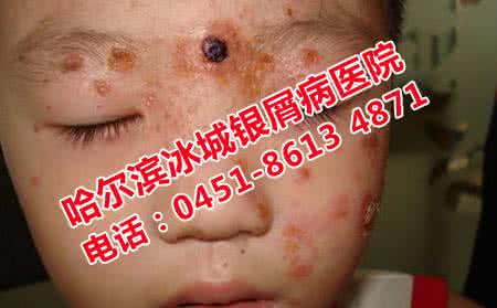 银屑病的饮食注意事项 银屑病的治疗 治疗得注意哪些事项