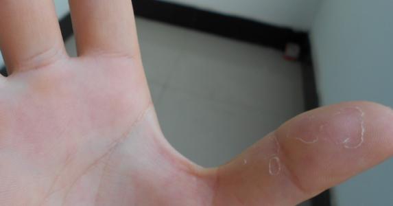灰指甲吃药副作用大吗 足贴对灰指甲有作用吗 足贴变灰是怎么回事？