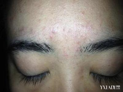 眉毛长痘痘是什么原因 眉毛上长痘痘是什么原因 眉毛上长痘痘解决方法