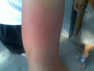 治疗虫咬性皮炎 虫咬性皮炎 虫咬性皮炎要怎么治疗