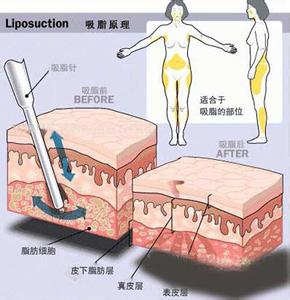 胖的部位可以吸脂减肥 吸脂减肥能瘦哪些部位 胖不是因为你吃得多，而是因为你太虚！各种部位瘦的办法，实用贴