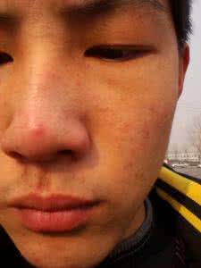 为什么脸上会长痤疮 脸上长痤疮怎么办 为什么脸上会长痤疮