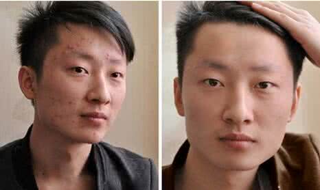 怎么防止脸上长痘痘 怎么防止长痘痘？