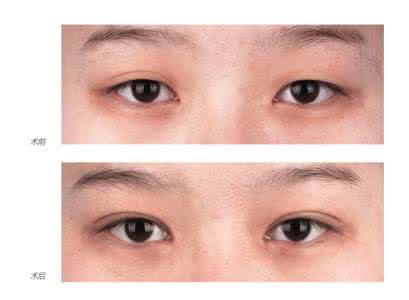 双眼皮手术恢复时间 补救手术 眼皮手术不满意时的补救