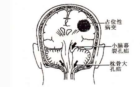 脑疝的早期症状 什么是脑疝 脑疝的症状表现有哪些