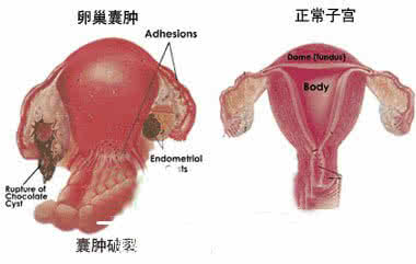 畸胎瘤是什么引起的 畸胎瘤是什么 畸胎瘤是怎么引起的