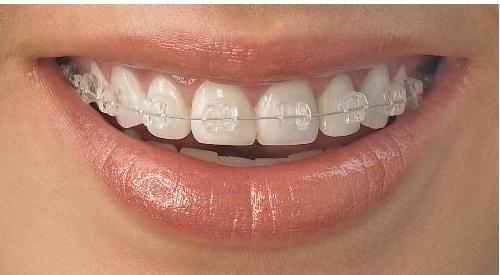 四环素牙齿美白 隐形牙箍 四环素牙齿美白