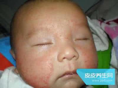 宝宝脸上长奶癣怎么治 宝宝长奶癣怎么办