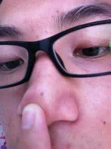 脸上有黑斑怎么回事 脸上长黑斑会是怎么回事呢?