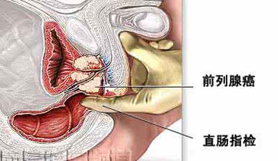前列腺癌的治疗方案 前列腺癌 治疗前列腺癌