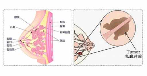 乳腺肿瘤能治好吗 乳腺肿瘤怎么治 教你正确认识乳腺肿瘤