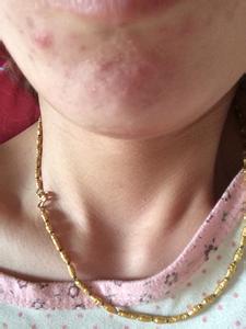 闭合性粉刺怎么治疗 粉刺 粉刺怎么治疗？