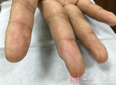 手指脱皮的原因及治疗 手指脱皮是什么原因 如何治疗手指脱皮