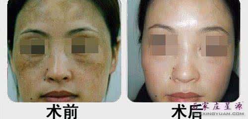 激光治疗太田痣效果 超强超短激光 盘点8种痣 激光治疗超强效