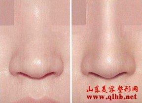 隆鼻后吃什么消肿快 隆鼻吃什么蔬菜？