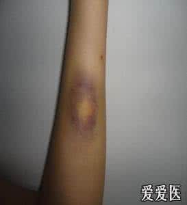 内痔出血的注意事项 皮下出血 皮下出血的注意事项