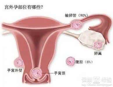 宫外孕怎么治疗最好 宫外孕早期症状