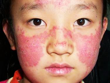 小儿系统性红斑狼疮 小儿系统性红斑狼疮 13种症状你会识别吗