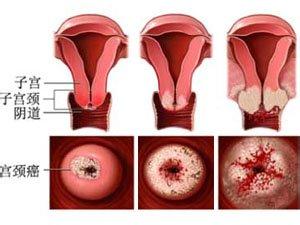 子宫肥大是怎么治疗 子宫肥大是怎么治疗呢 子宫肥大如何治疗