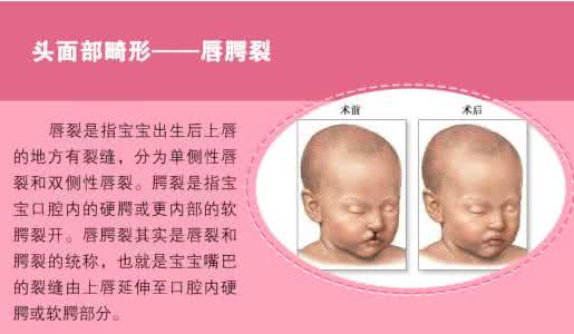 如何预防胎儿畸形 导致胎儿畸形的原因 如何预防胎儿畸形