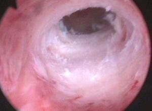 宫腔粘连怎么治疗 宫腔粘连 宫腔粘连怎么治疗