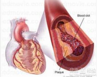 动脉粥样硬化病理过程 动脉粥样硬化是一种生活方式病
