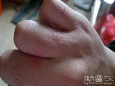 如何治疗过敏性湿疹 过敏性湿疹 如何治疗过敏性湿疹