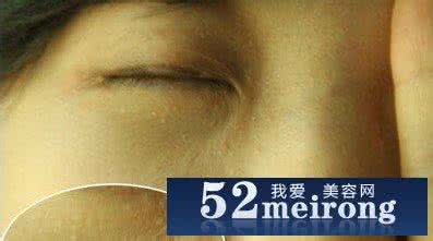 敷面膜会长脂肪粒吗 面膜做多了会长脂肪粒吗