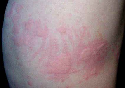 荨麻疹不吃药能好吗 荨麻疹不吃药能好吗 荨麻疹好了能吃辣椒吗？